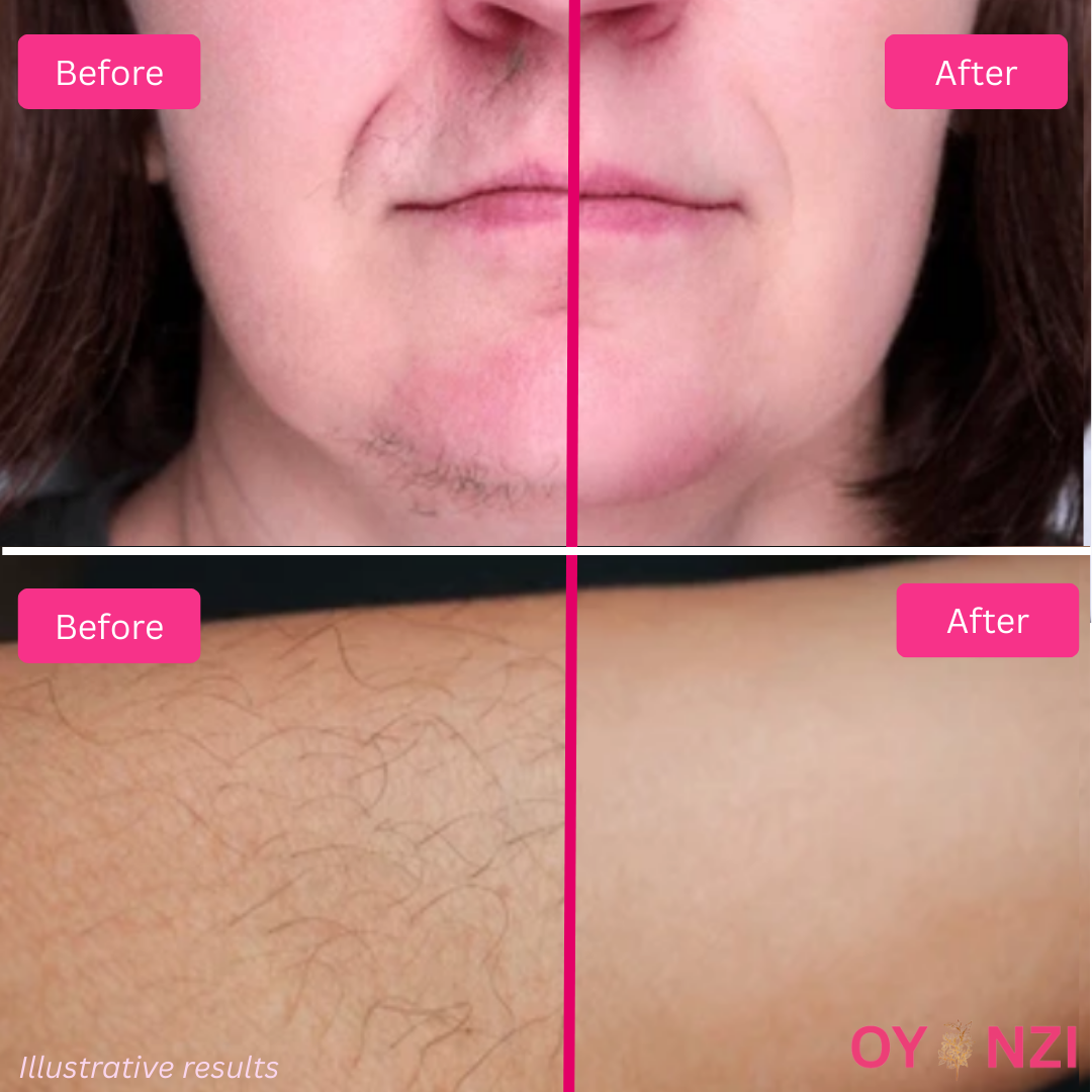 Oyanzi™ Hair Reduction Oil